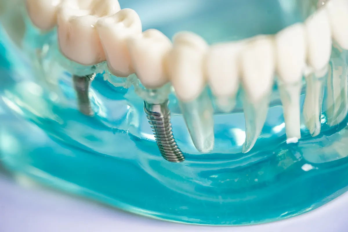 An illustration depicting the steps involved in the dental implant placement process.