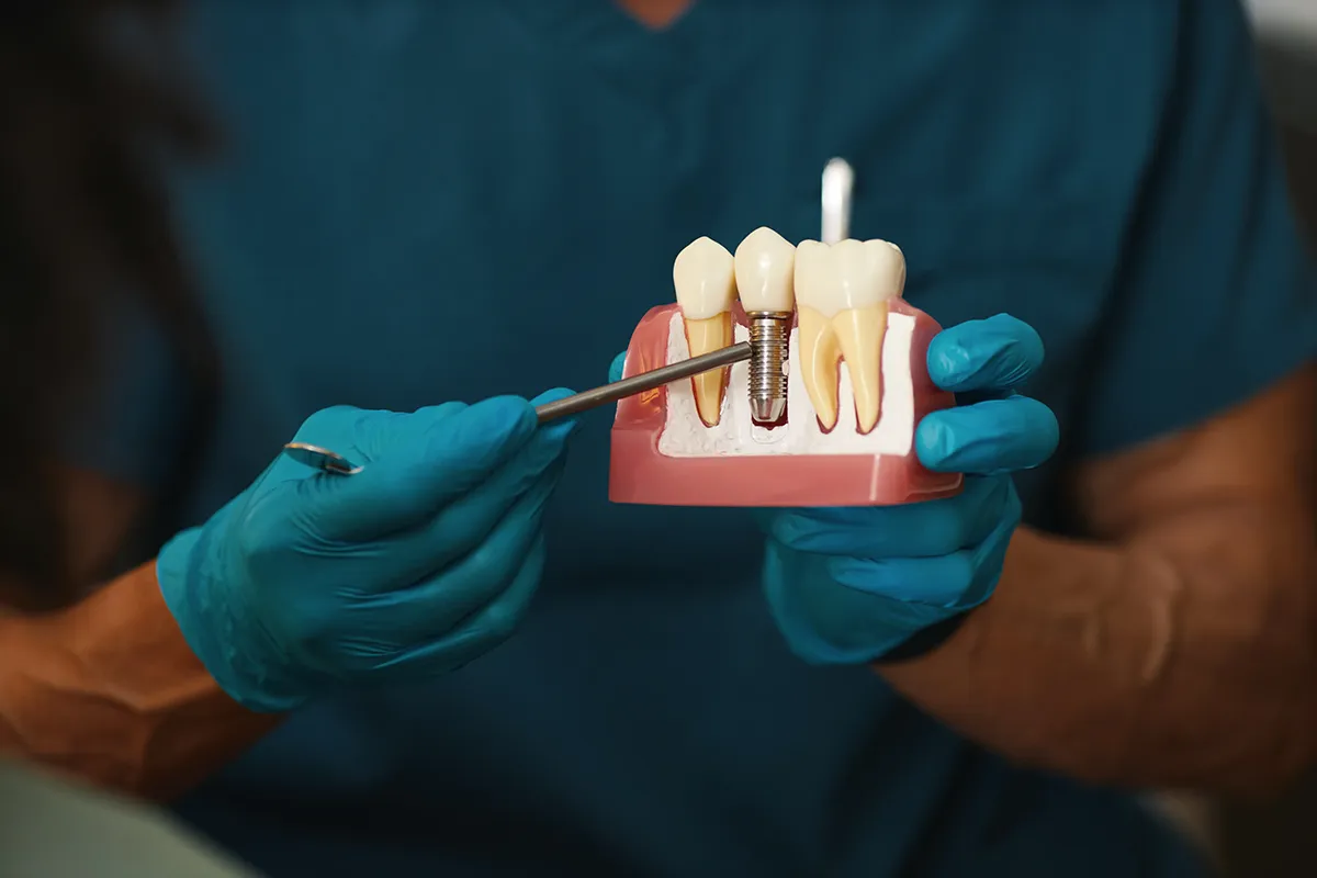 Different types of dental implants and tooth replacements displayed together.