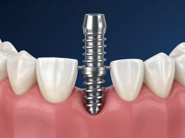 Dental Implants Cost in Ontario 2026: Full Price Breakdown