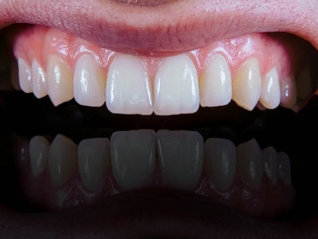 All-on-4 Dental Implants in Guelph: 2026 Cost & Procedure Guide
